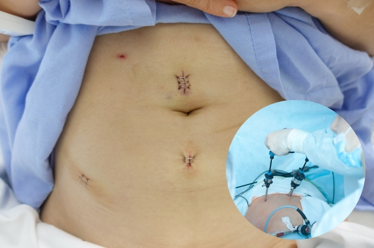 Laparoscopic Myomectomy & Cystectomy ----33